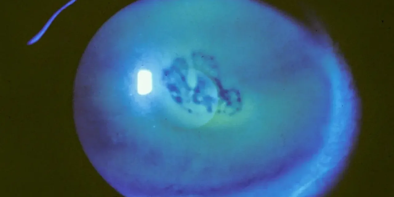 Recurrent Corneal Erosion: Why Mornings Are the Worst
