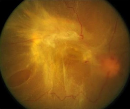 Combined Rhegmatogenous-Tractional Retinal Detachment