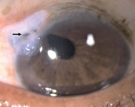 Corneal Wound Dehiscence