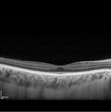 Clinical eye photograph illustrating Albinism Foveal Hypoplasia Oct