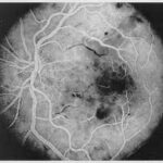 Interferon Retinopathy
