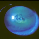 Recurrent Corneal Erosion
