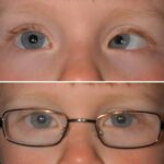 Clinical eye photograph illustrating Accommodative Esotropia Management