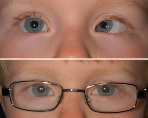 Accommodative Esotropia: Getting the Glasses Prescription Right Before Considering Surgery