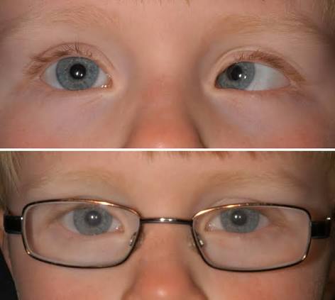Accommodative Esotropia: Getting the Glasses Prescription Right Before Considering Surgery