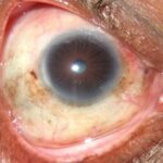 Leprosy: Ocular Involvement in Hansen's Disease