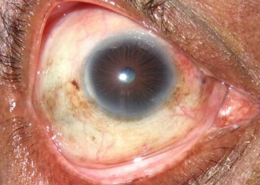 Leprosy: Ocular Involvement in Hansen’s Disease