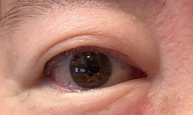 Epiblepharon: The Lash-Turning Fold That Isn’t Entropion