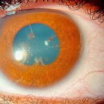 Juvenile Idiopathic Arthritis-Associated Uveitis