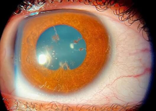 Juvenile Idiopathic Arthritis-Associated Uveitis: The Silent Threat