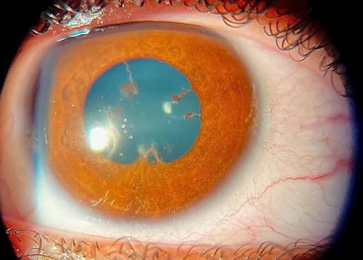 Juvenile Idiopathic Arthritis-Associated Uveitis: The Silent Threat