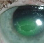 Neurotrophic Keratopathy