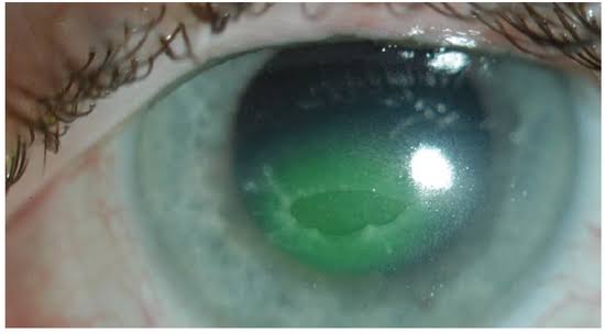 Neurotrophic Keratopathy: When the Cornea Can’t Feel Its Own Damage