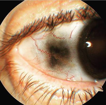 Alkaptonuria