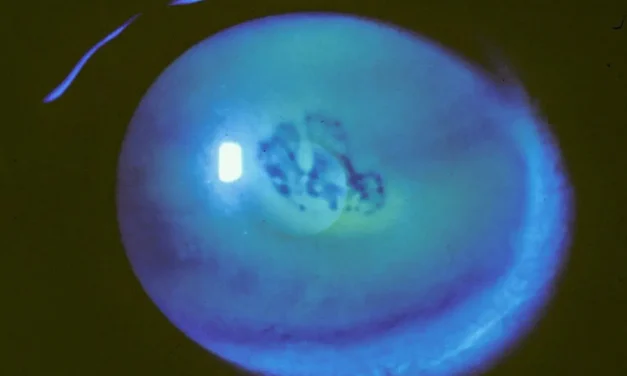 Recurrent Corneal Erosion: Why Mornings Are the Worst