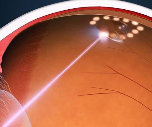 Laser Retinopexy