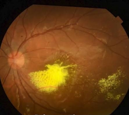 Retinal Cryotherapy