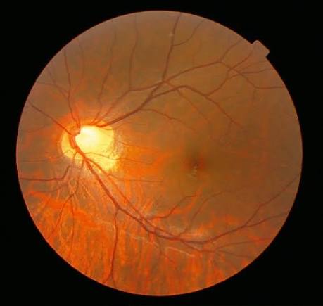 Congenital Stationary Night Blindness