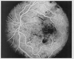 Interferon Retinopathy: Usually Silent, Usually Self-Limited