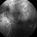 HIV retinopathy and immune recovery uveitis: fluorescein angiogram showing diffuse retinal vascular leakage in immune recovery uveitis