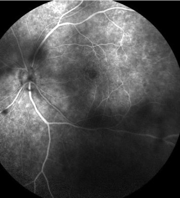 HIV Retinopathy and Immune Recovery Uveitis: Two Faces of Retinal Disease in HIV