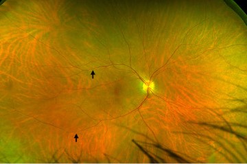 HIV retinopathy and immune recovery uveitis: ultra-widefield fundus image with arrows marking retinal changes at two-year follow-up