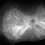 Indocyanine green angiography: angiogram showing the choroidal vascular pattern