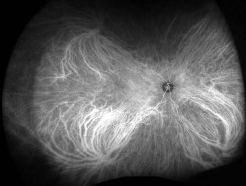 Indocyanine Green Angiography: Seeing the Choroid Fluorescein Cannot