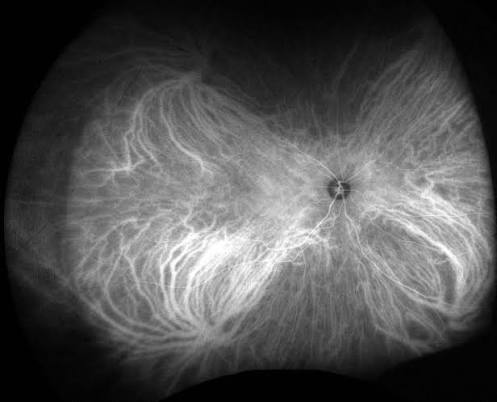 Indocyanine Green Angiography Choroidal Vessels Indocyanine green angiography: angiogram showing the choroidal vascular pattern