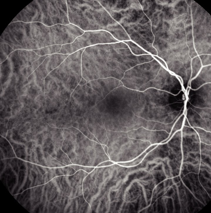 Indocyanine Green Angiography Macular Vessels Indocyanine green angiography: angiogram of the macula showing the choroidal vessel pattern around the fovea