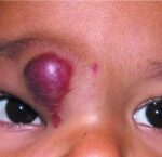 Infantile periocular capillary hemangioma: a red vascular lesion over the medial upper eyelid in a young child