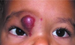 Infantile Periocular Capillary Hemangioma: A Race Against Amblyopia