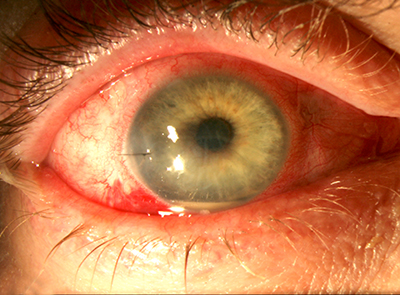 Intracameral antibiotics for endophthalmitis prophylaxis: eye with diffuse conjunctival injection after cataract surgery