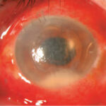 Intracameral antibiotics for endophthalmitis prophylaxis: eye with conjunctival injection and a corneal infiltrate after cataract surgery