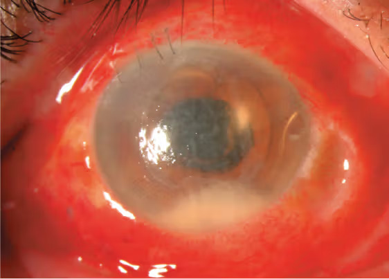 Intracameral Antibiotics: Prophylaxis Aimed at the Moment of Highest Risk