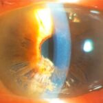 Iridoschisis: slit-lamp photograph showing splitting of the anterior iris stroma with floating fibrillar strands