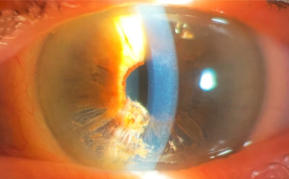 Iridoschisis: When the Iris Splits and the Glaucoma Is What Matters