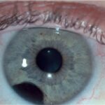 Iris melanoma: slit-lamp photograph of a heavily pigmented lesion in the inferotemporal iris