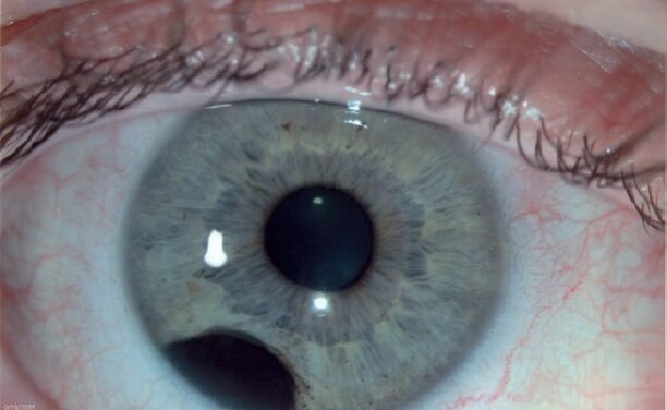 Iris Melanoma: The Uveal Melanoma You Can Actually See