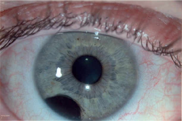 Iris Melanoma Pigmented Lesion Iris melanoma: slit-lamp photograph of a heavily pigmented lesion in the inferotemporal iris