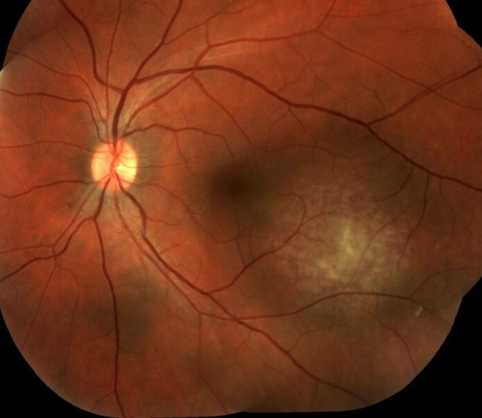 Choroidal Hemangioma