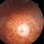 Juvenile open-angle glaucoma: fundus photograph showing a large myopic optic disc with a cup-to-disc ratio of about 0.9 and neuroretinal rim thinning