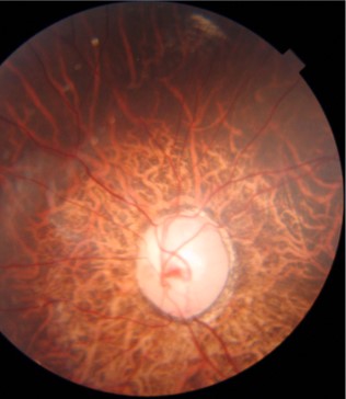 Juvenile Open-Angle Glaucoma: A Genetic Disease That Doesn’t Wait