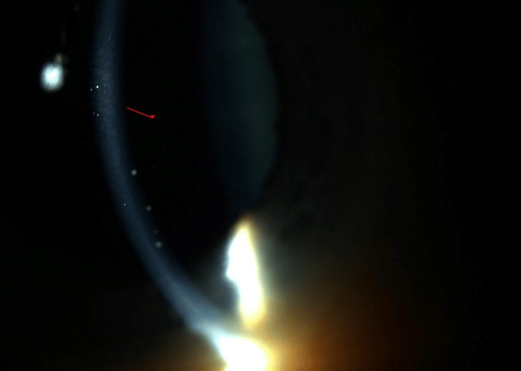 Keratic precipitates: narrow-beam slit-lamp image showing keratic precipitates and anterior chamber reaction