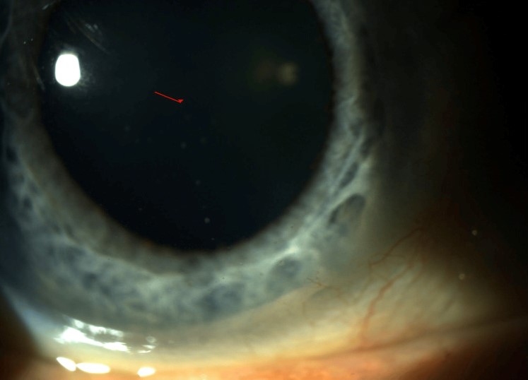 Keratic precipitates: slit-lamp photograph showing multiple mutton-fat keratic precipitates on the corneal endothelium