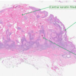 Keratoacanthoma: low-power H&E histology showing a crateriform lesion with a central keratin-filled crater and acanthotic epithelium