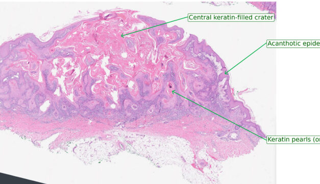 Keratoacanthoma of the Eyelid: Fast-Growing but Hard to Trust