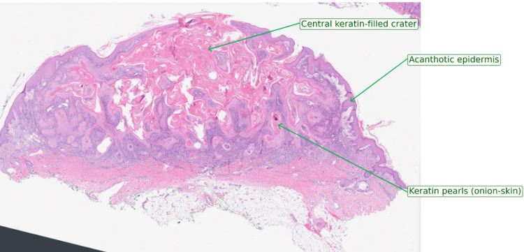 Keratoacanthoma of the Eyelid: Fast-Growing but Hard to Trust