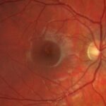 Laser pointer maculopathy: fundus photograph showing a foveal lesion after laser exposure