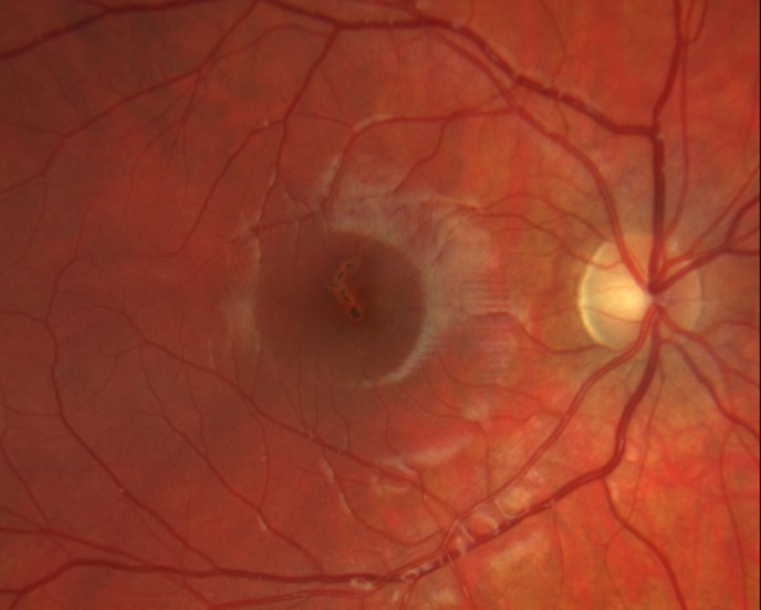 Laser Pointer Maculopathy Foveal Lesion Laser pointer maculopathy: fundus photograph showing a foveal lesion after laser exposure